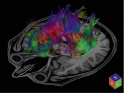 Tractography of the brain acquired with a DTI scan in 49 directions