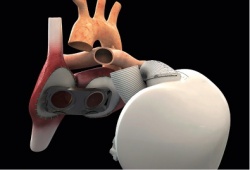 The ‘self-regulating’ artificial heart refers to the ability to speed up or...