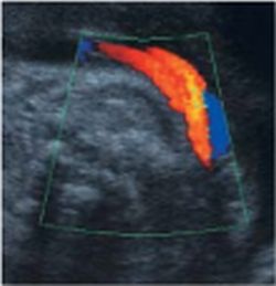 Figure 1: Representation of the umbilical cord vessels with conventional colour...