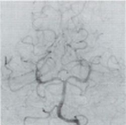 This image shows the aneurysm on page 16 after embolization with platinum...