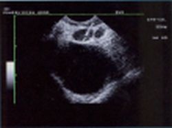 Fig. 7: FNAB of suspected Iymph node in a patient with primary lung tumor....