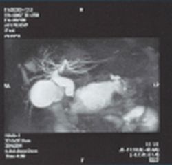 Figure 1: Giant pancreatic cyst, 3D-MRCp