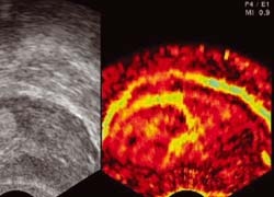 Fig 1: On the right prostate lobe, a hyperechoic area in B-mode shows no...