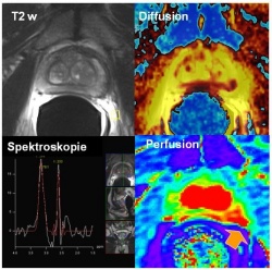 Fig.1: Multiparametric 3-Tesla-MRI of the prostate in a patient with multifocal...