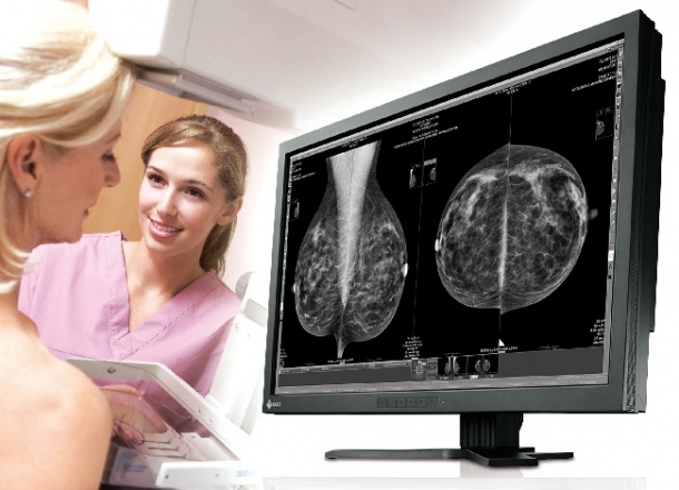 Photo: The vicissitudes of breast screening