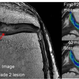 Anatomical and biochemical imaging (in colour) of kneecap cartilage damage