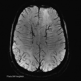 High-res image of the smalles cerebral vessels on submillimetre level with...