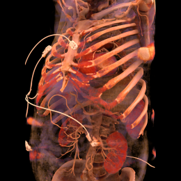 Skelett mit Schädel, Rippen, Brustbein und Becken. Hinter den Rippen sieht man...