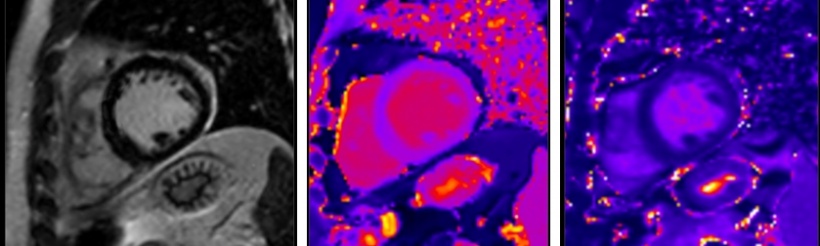 Where standard MR imaging (left) cannot detect anomalies, new mapping...