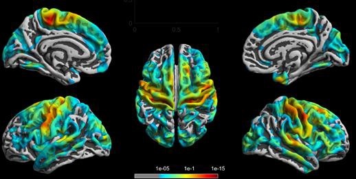 cortical atrophy in ms patients