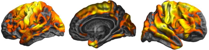 brain images of ms patients