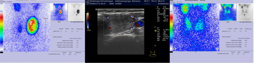 Autonomous thyroid adenoma pre-therapy (left and middle) and post-therapy...