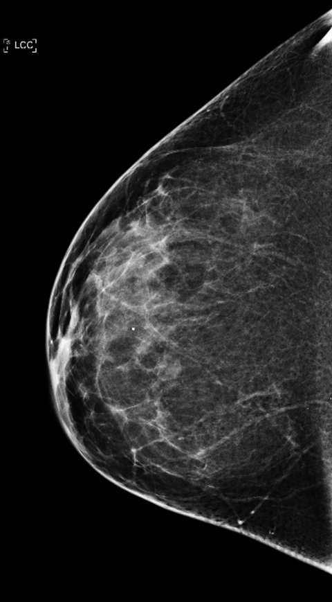 mammography of healthy breast